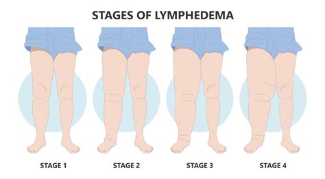 water leaking from leg|Lymphoedema